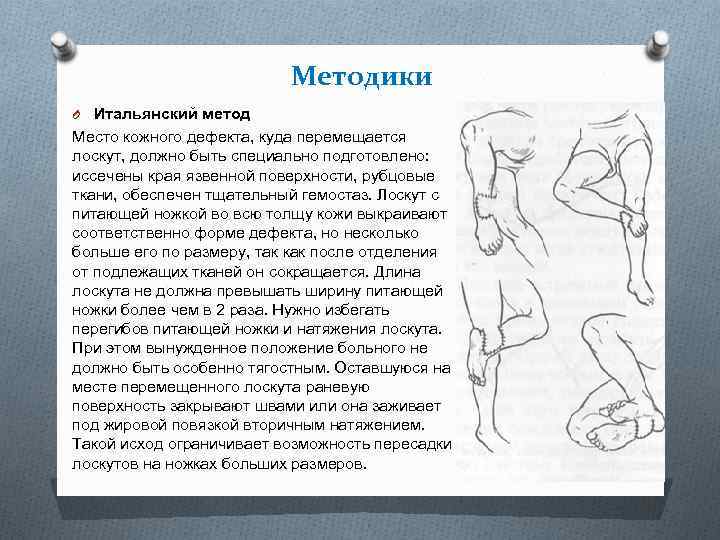 Методики O Итальянский метод Место кожного дефекта, куда перемещается лоскут, должно быть специально подготовлено: