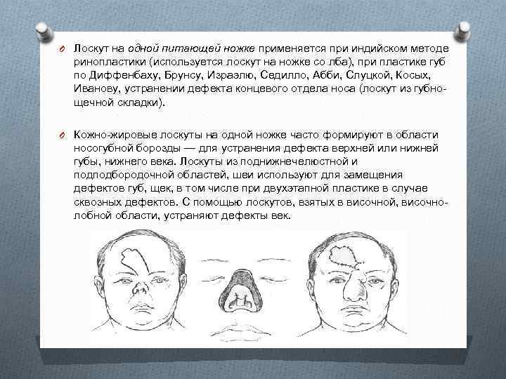 O Лоскут на одной питающей ножке применяется при индийском методе ринопластики (используется лоскут на