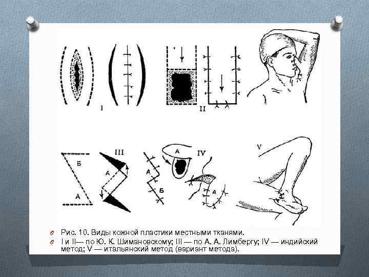 O O Рис. 10. Виды кожной пластики местными тканями. I и II— по Ю.