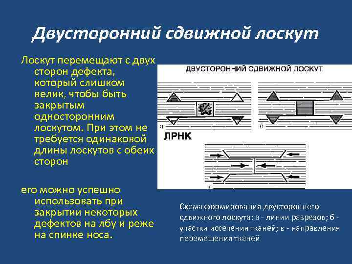 Двусторонний сдвижной лоскут Лоскут перемещают с двух сторон дефекта, который слишком велик, чтобы быть