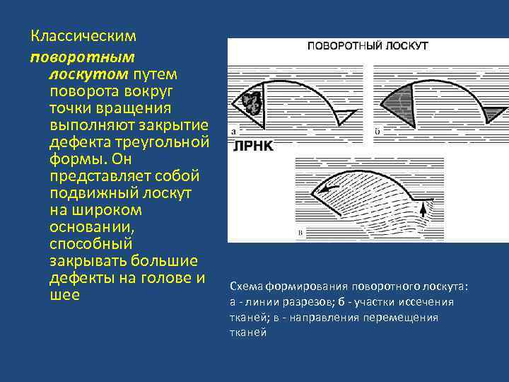 Классическим поворотным лоскутом путем поворота вокруг точки вращения выполняют закрытие дефекта треугольной формы. Он