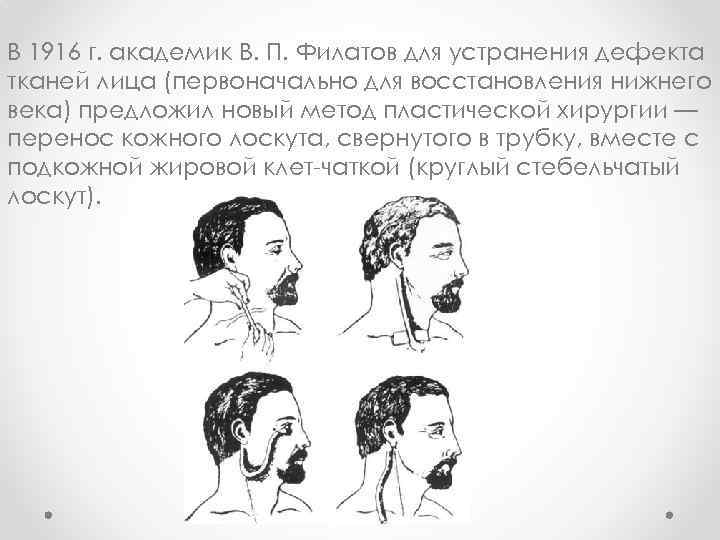 В 1916 г. академик В. П. Филатов для устранения дефекта тканей лица (первоначально для