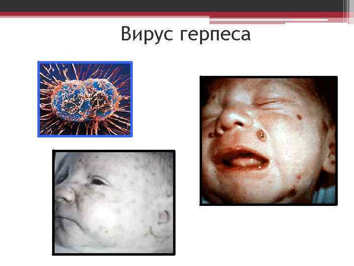 Вирус герпеса 