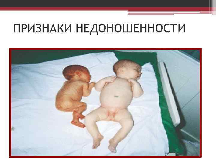 ПРИЗНАКИ НЕДОНОШЕННОСТИ 