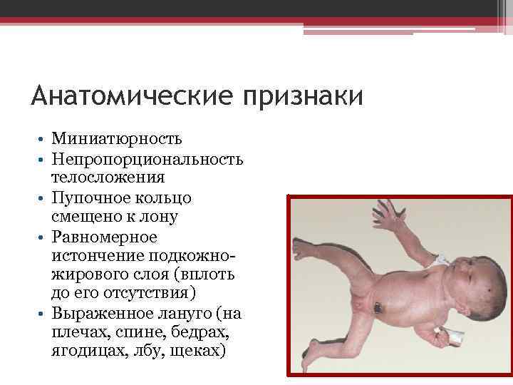 Анатомические признаки • Миниатюрность • Непропорциональность телосложения • Пупочное кольцо смещено к лону •