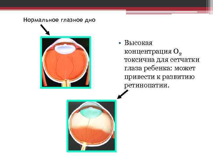 Нормальное глазное дно • Высокая концентрация О 2 токсична для сетчатки глаза ребенка: может