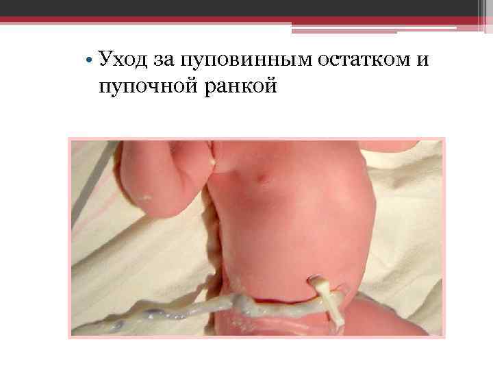  • Уход за пуповинным остатком и пупочной ранкой 