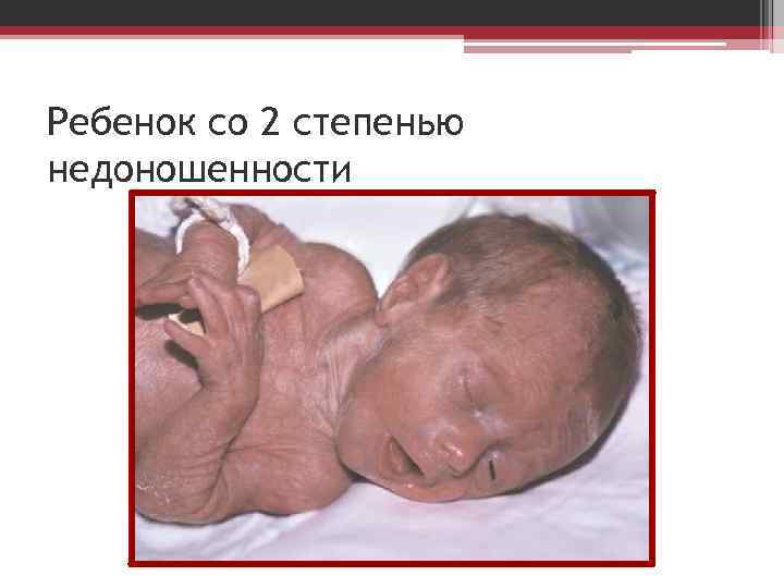 Ребенок со 2 степенью недоношенности 