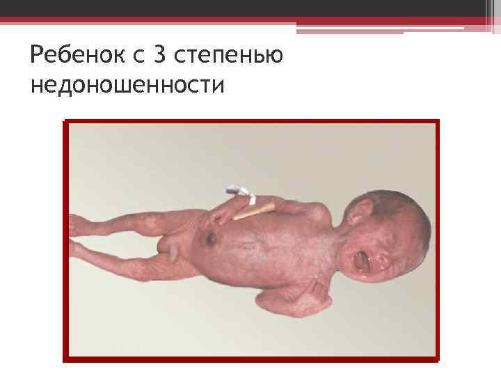 Ребенок с 3 степенью недоношенности 