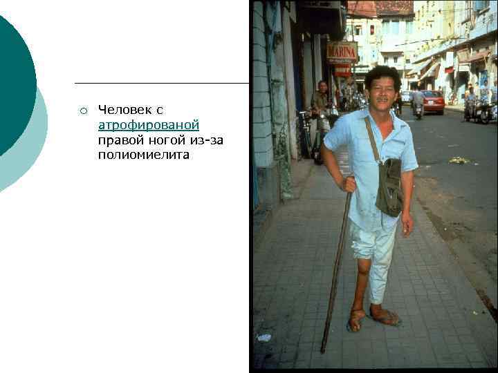 ¡ Человек с атрофированой правой ногой из-за полиомиелита 