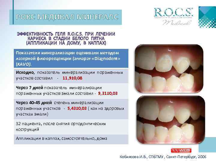 РОКС МЕДИКАЛ МИНЕРАЛС ЭФФЕКТИВНОСТЬ ГЕЛЯ R. O. C. S. ПРИ ЛЕЧЕНИИ КАРИЕСА В СТАДИИ