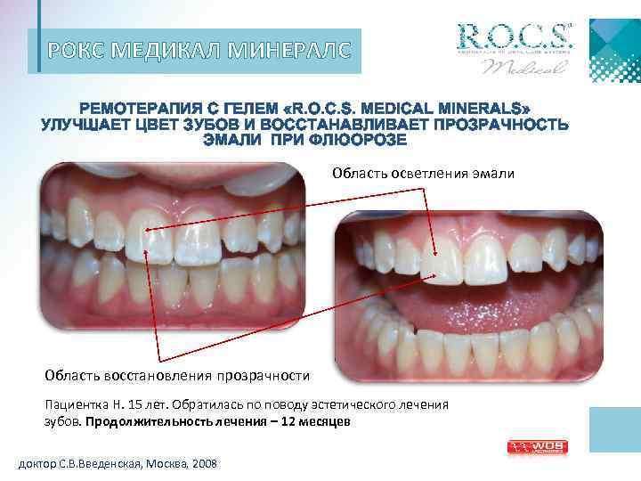 РОКС МЕДИКАЛ МИНЕРАЛС РЕМОТЕРАПИЯ С ГЕЛЕМ «R. O. C. S. MEDICAL MINERALS» УЛУЧШАЕТ ЦВЕТ
