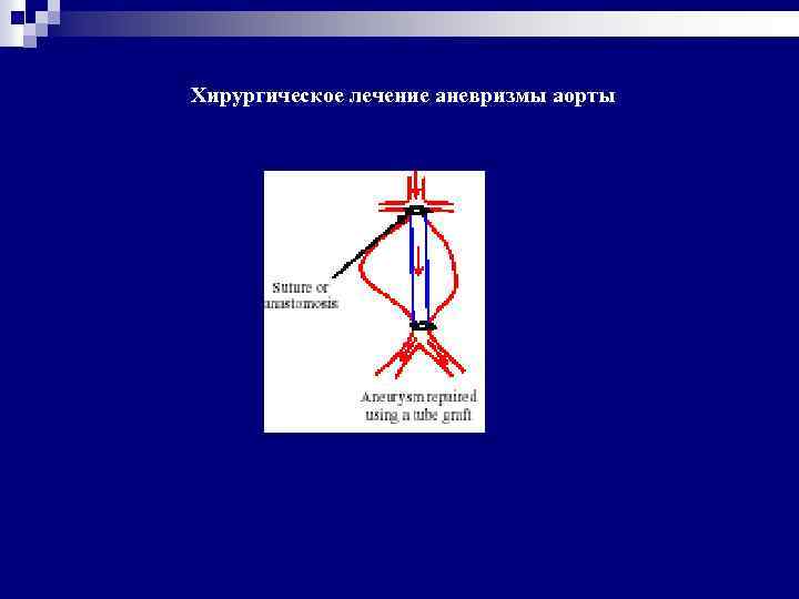 Хирургическое лечение аневризмы аорты 