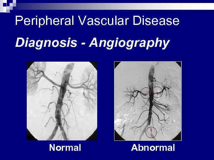 Peripheral Vascular Disease Diagnosis - Angiography Normal Abnormal 