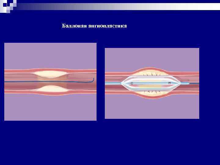 Баллоная ангиопластика 