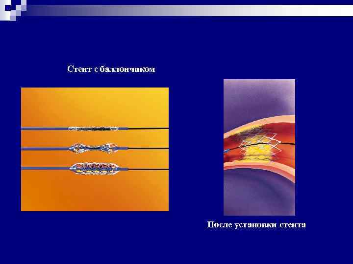 Стент с баллончиком После установки стента 