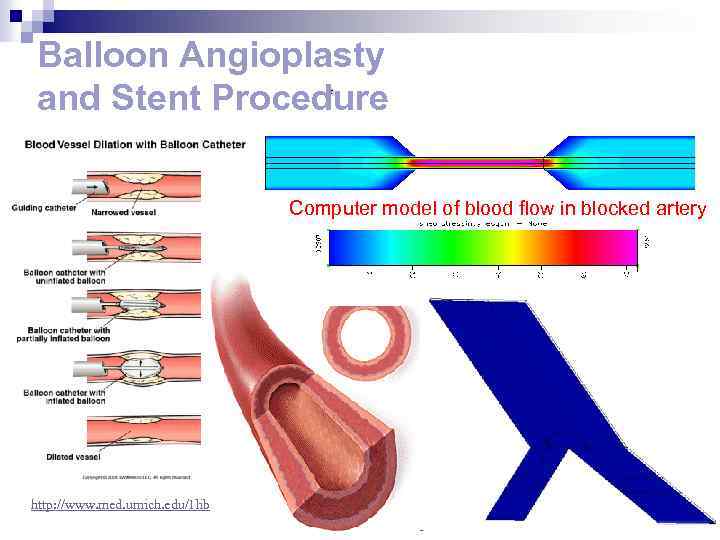 Balloon Angioplasty and Stent Procedure Computer model of blood flow in blocked artery http: