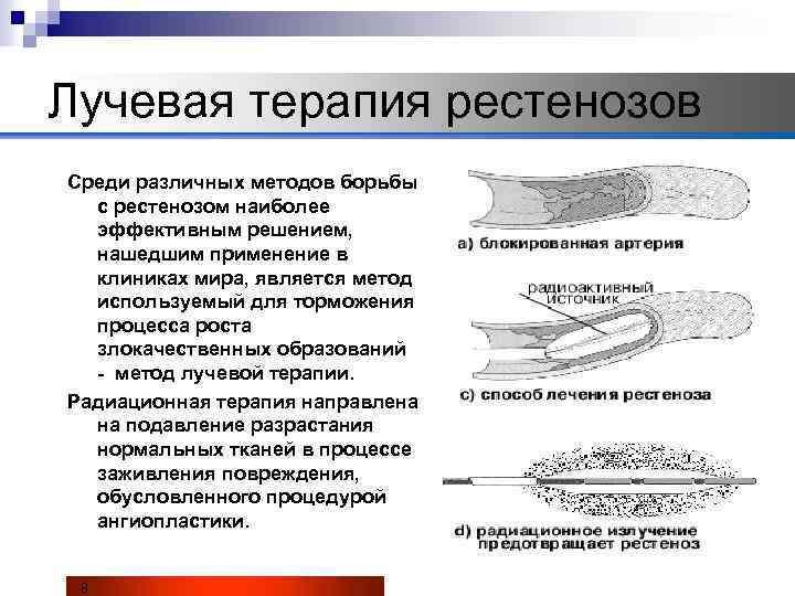 Лучевая терапия рестенозов Среди различных методов борьбы с рестенозом наиболее эффективным решением, нашедшим применение