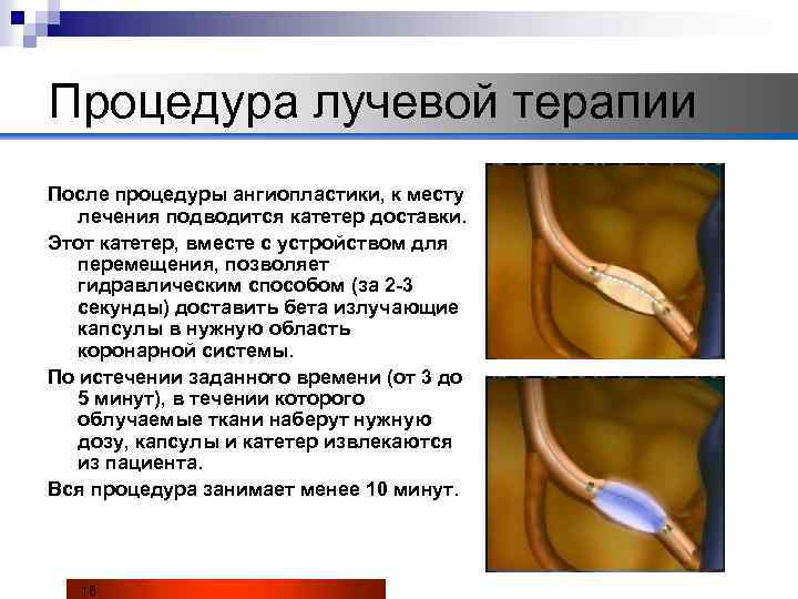 Процедура лучевой терапии После процедуры ангиопластики, к месту лечения подводится катетер доставки. Этот катетер,