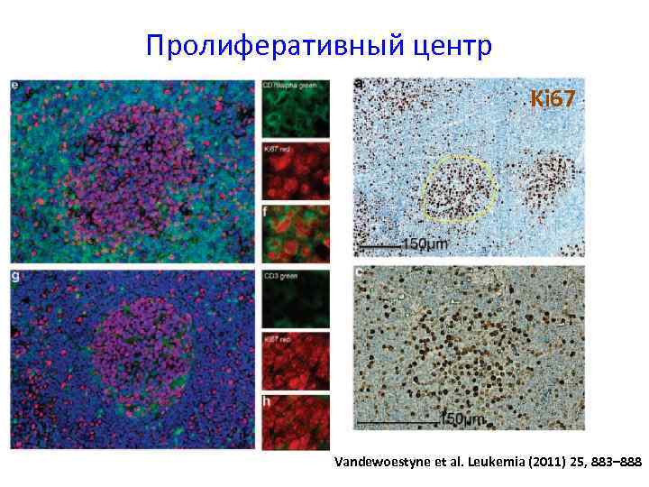 Пролиферативный центр Ki 67 Vandewoestyne et al. Leukemia (2011) 25, 883– 888 