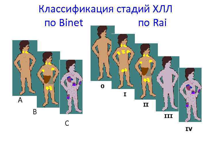 Классификация стадий ХЛЛ по Binet по Rai 0 I A II B C III