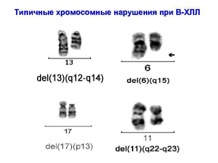 Типичные хромосомные нарушения при В-ХЛЛ 