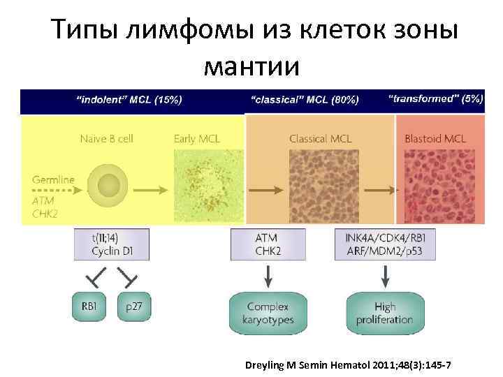 B-клеточная лимфома из клеток мантийной зоны.. Лимфома из клеток зоны мантии. Лимфомы из клеток маргинальной зоны. Лимфома из клеток зоны мантии 4 стадия.