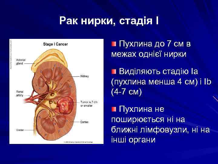 Рак нирки, стадія І Пухлина до 7 см в межах однієї нирки Виділяють стадію