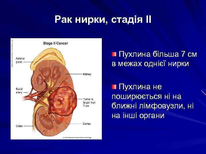 Рак нирки, стадія ІІ Пухлина більша 7 см в межах однієї нирки Пухлина не