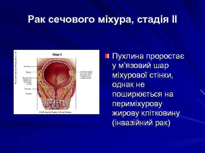 Рак сечового міхура, стадія ІІ Пухлина проростає у м’язовий шар міхурової стінки, однак не