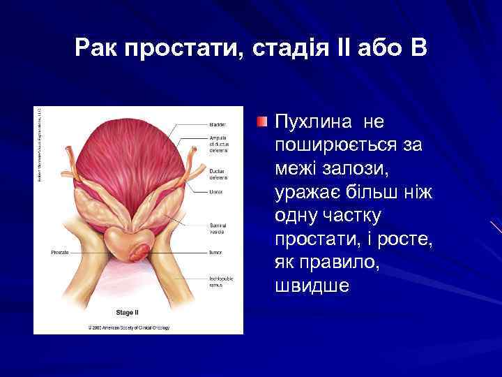 Рак простати, стадія IІ або В Пухлина не поширюється за межі залози, уражає більш