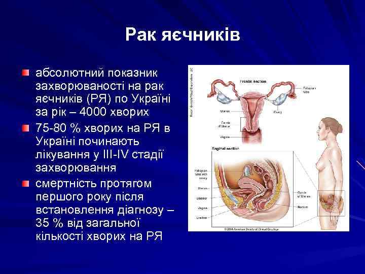 Рак яєчників абсолютний показник захворюваності на рак яєчників (РЯ) по Україні за рік –