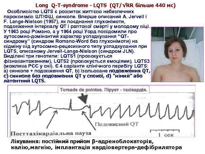 Long Q-T-syndrome - LQTS (QT/√RR більше 440 мс) Особливістю LQTS є розвиток життєво небезпечних