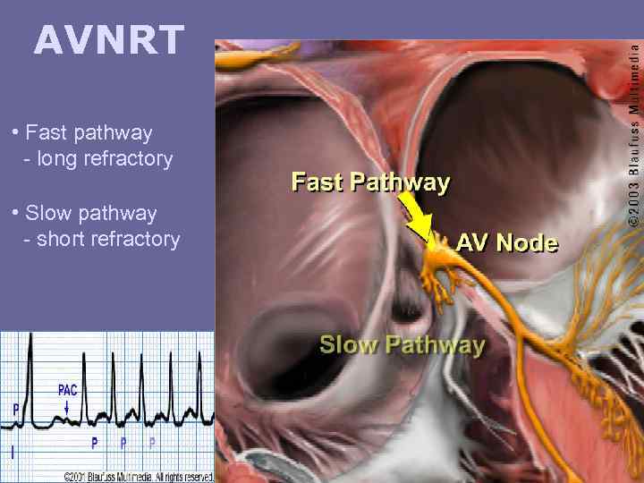 AVNRT • Fast pathway - long refractory • Slow pathway - short refractory 
