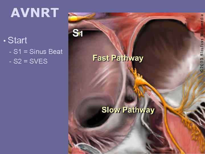 AVNRT • Start - S 1 = Sinus Beat - S 2 = SVES