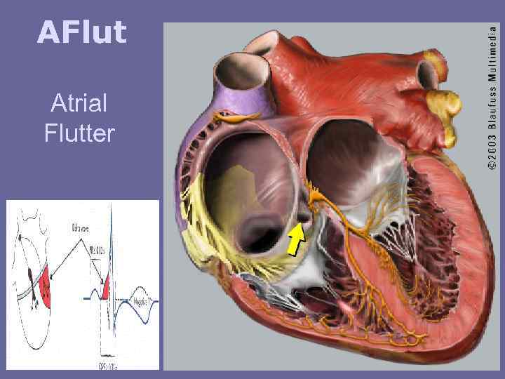 AFlut Atrial Flutter 