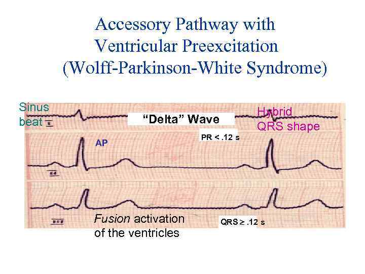 Accessory Pathway with Ventricular Preexcitation (Wolff-Parkinson-White Syndrome) Sinus beat “Delta” Wave AP Fusion activation