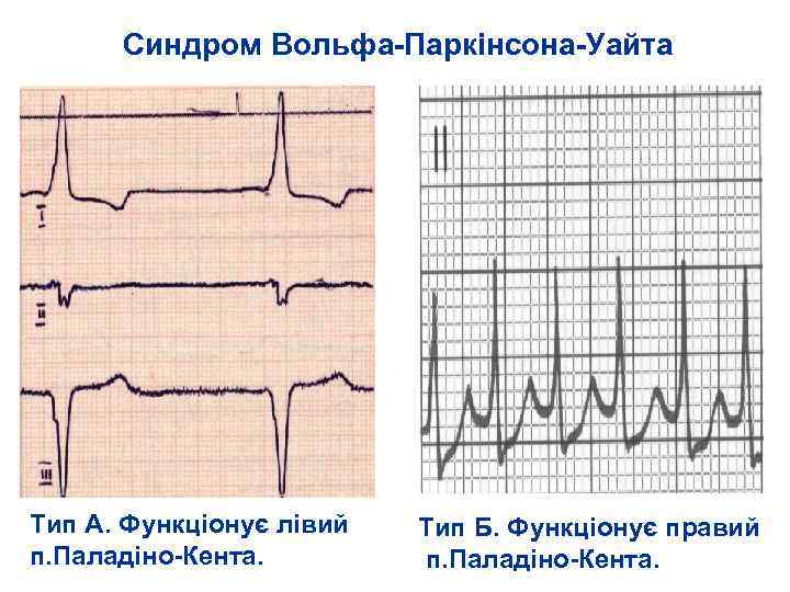 Синдром Вольфа-Паркінсона-Уайта Тип А. Функціонує лівий п. Паладіно-Кента. Тип Б. Функціонує правий п. Паладіно-Кента.