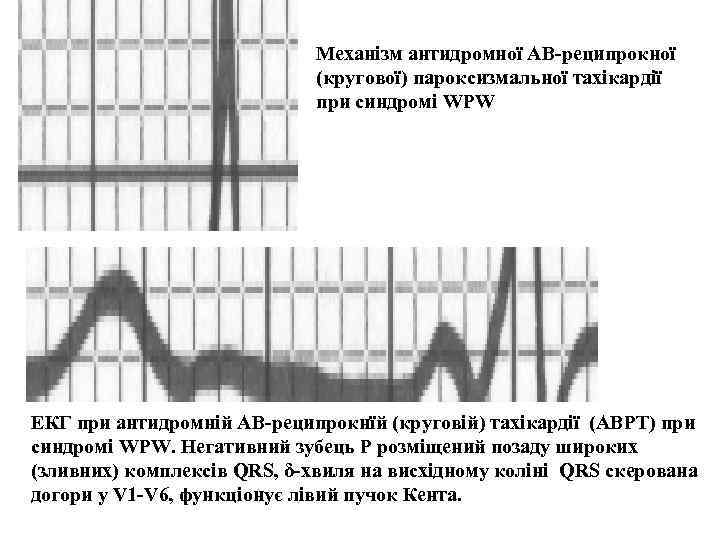 Механізм антидромної АВ-реципрокної (кругової) пароксизмальної тахікардії при синдромі WPW ЕКГ при антидромній АВ-реципрокнїй (круговій)