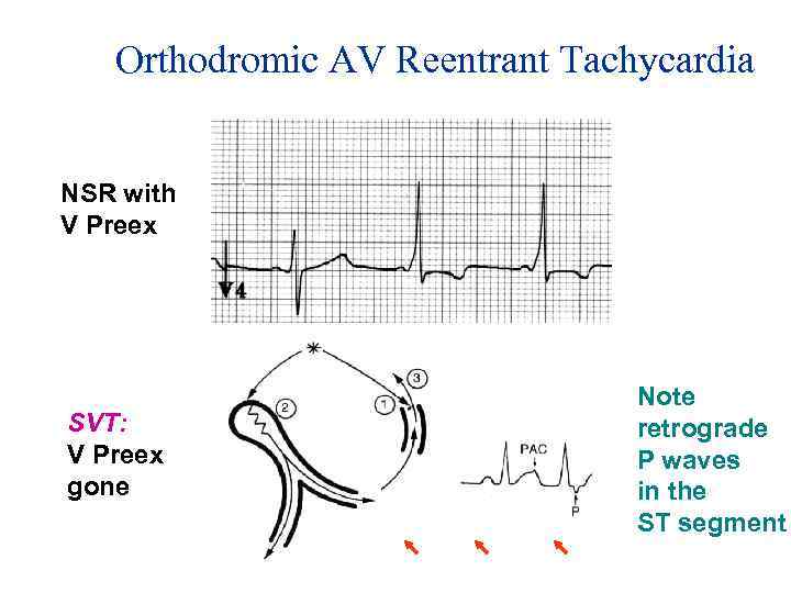 Orthodromic AV Reentrant Tachycardia NSR with V Preex SVT: V Preex gone Note retrograde
