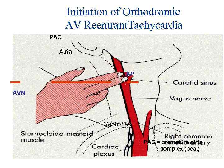 Initiation of Orthodromic AV Reentrant. Tachycardia PAC Atria AP AVN Ventricles PAC = premature