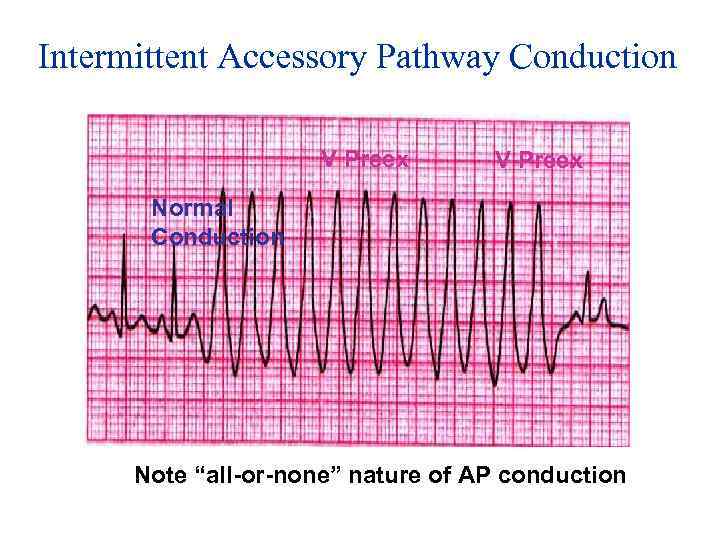Intermittent Accessory Pathway Conduction V Preex Normal Conduction Note “all-or-none” nature of AP conduction