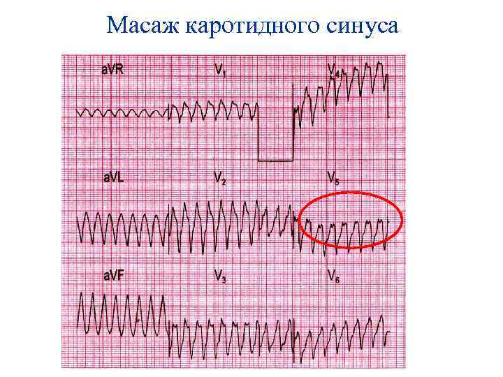 Масаж каротидного синуса 