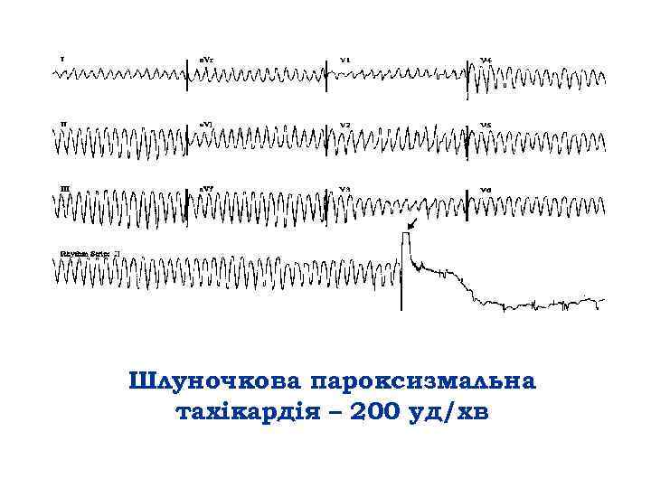Шлуночкова пароксизмальна тахікардія – 200 уд/хв 