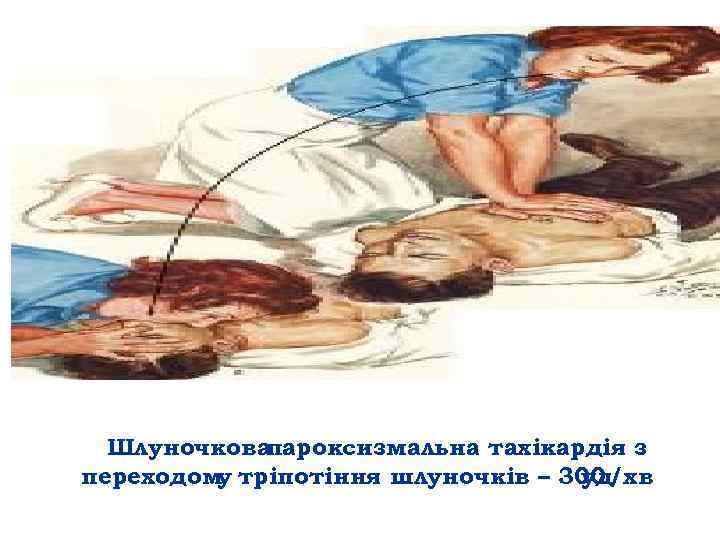 Шлуночкова пароксизмальна тахікардія з переходом тріпотіння шлуночків – 300 у уд/хв 