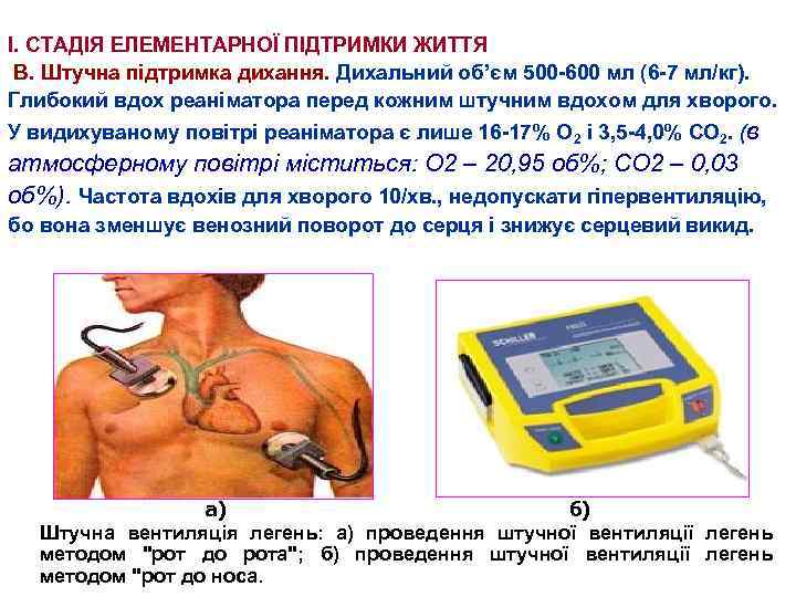 І. СТАДІЯ ЕЛЕМЕНТАРНОЇ ПІДТРИМКИ ЖИТТЯ В. Штучна підтримка дихання. Дихальний об’єм 500 -600 мл