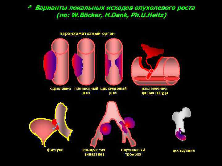 * Варианты локальных исходов опухолевого роста (по: W. Böcker, H. Denk, Ph. U. Heitz)