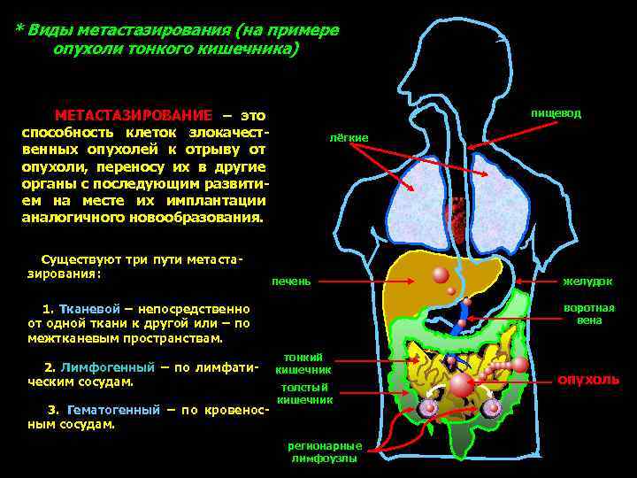 Рак желудка метастазы