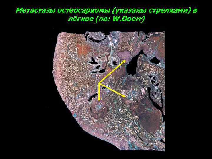 Метастазы остеосаркомы (указаны стрелками) в лёгкое (по: W. Doerr) 