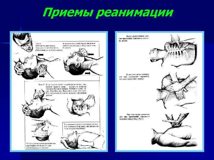 Приемы реанимации 